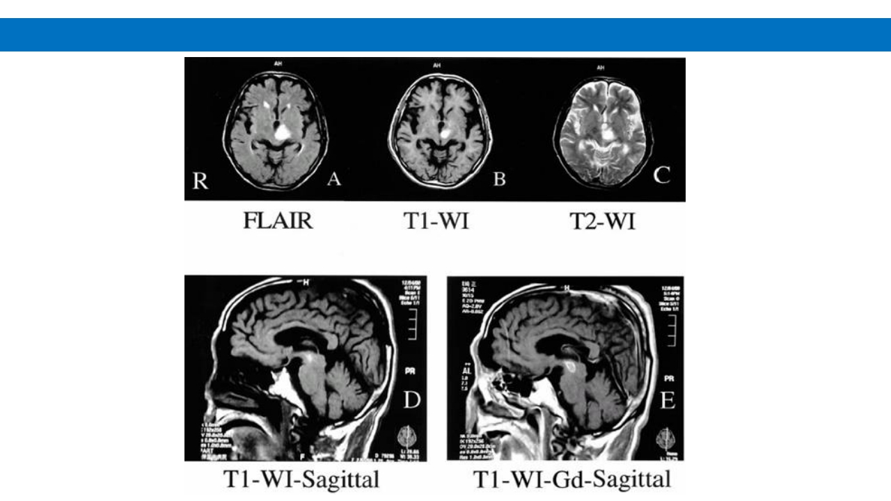 颅脑损伤的并发症及后遗症PPT课件41