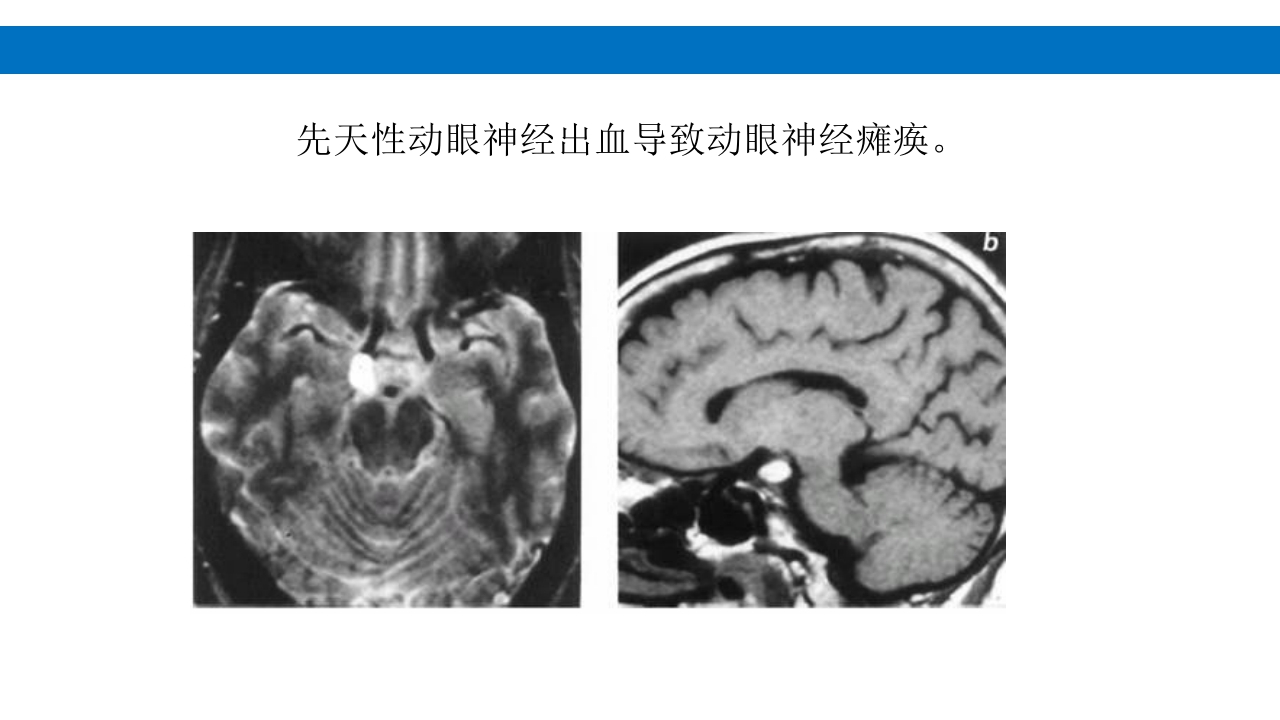 颅脑损伤的并发症及后遗症PPT课件42