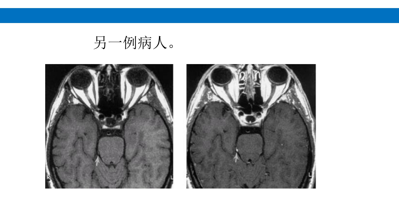 颅脑损伤的并发症及后遗症PPT课件44
