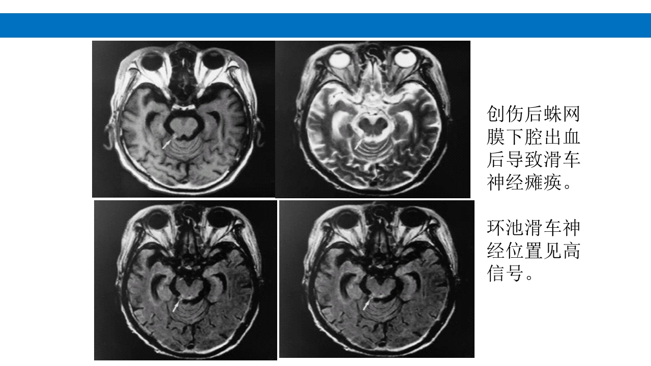 颅脑损伤的并发症及后遗症PPT课件45