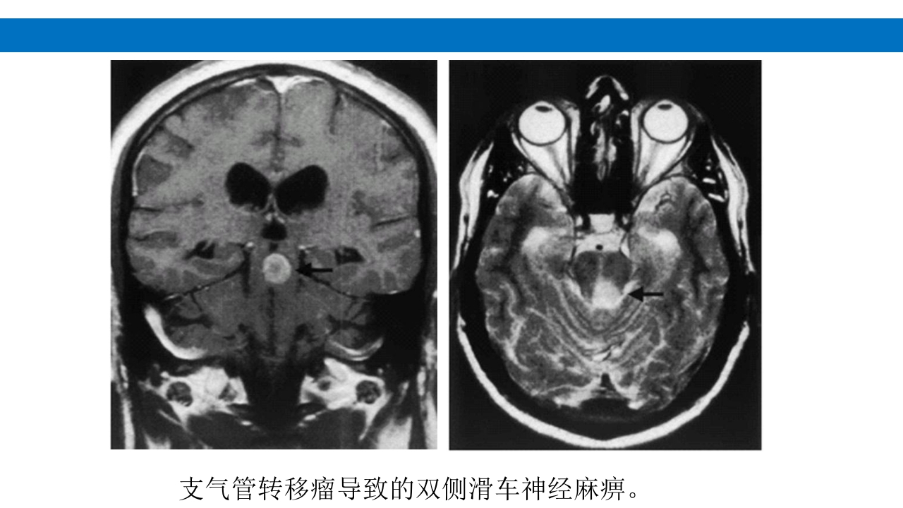 颅脑损伤的并发症及后遗症PPT课件46