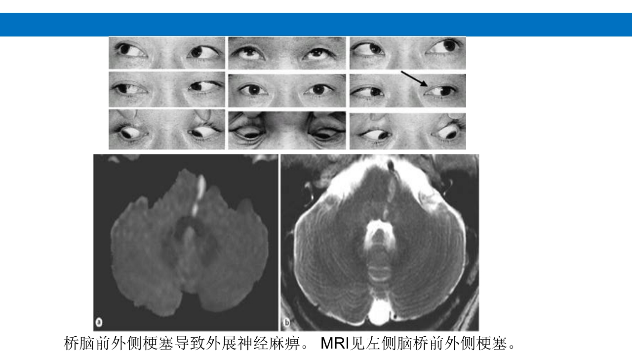 颅脑损伤的并发症及后遗症PPT课件47