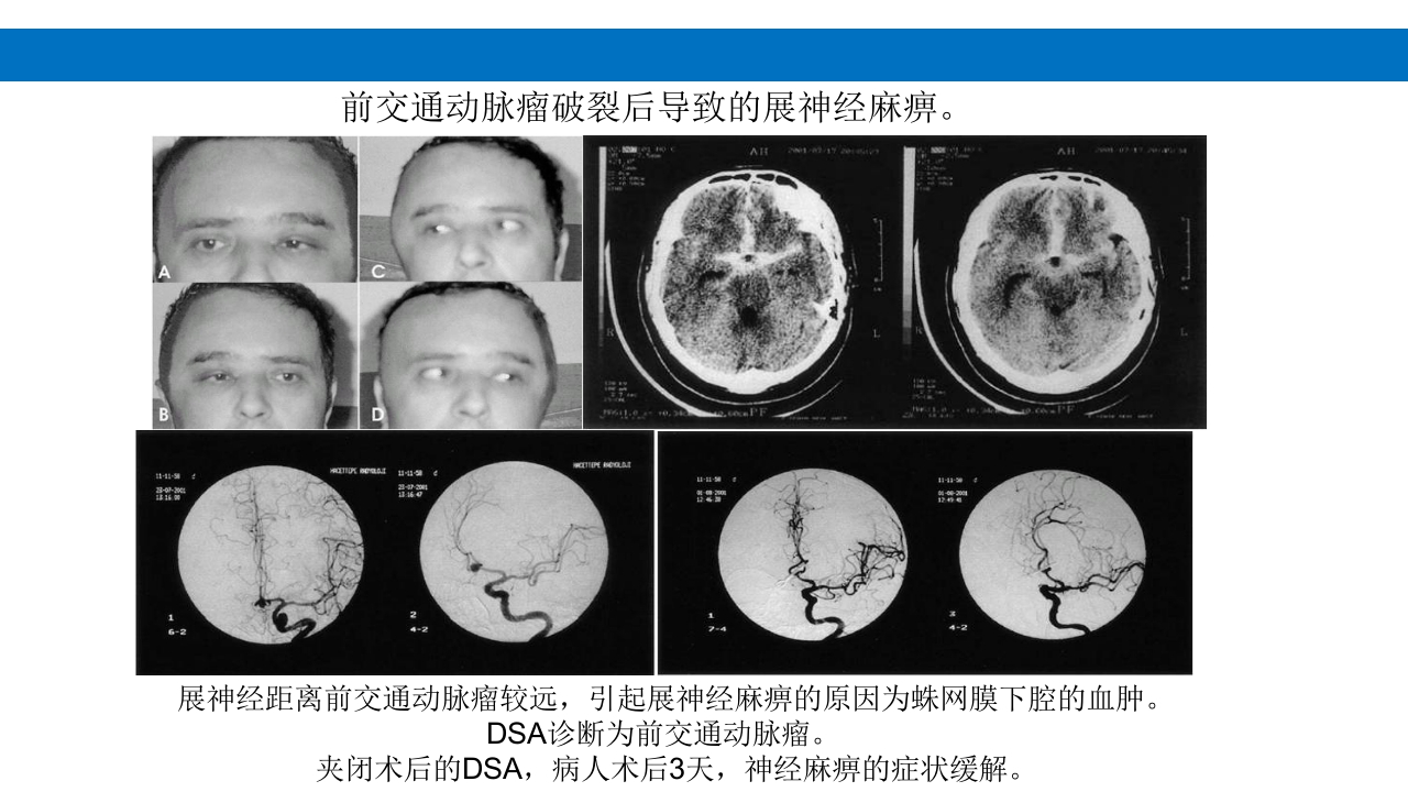 颅脑损伤的并发症及后遗症PPT课件51
