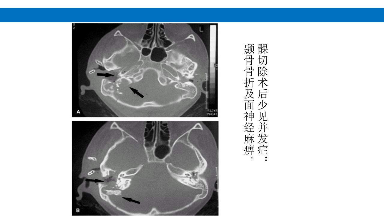 颅脑损伤的并发症及后遗症PPT课件53