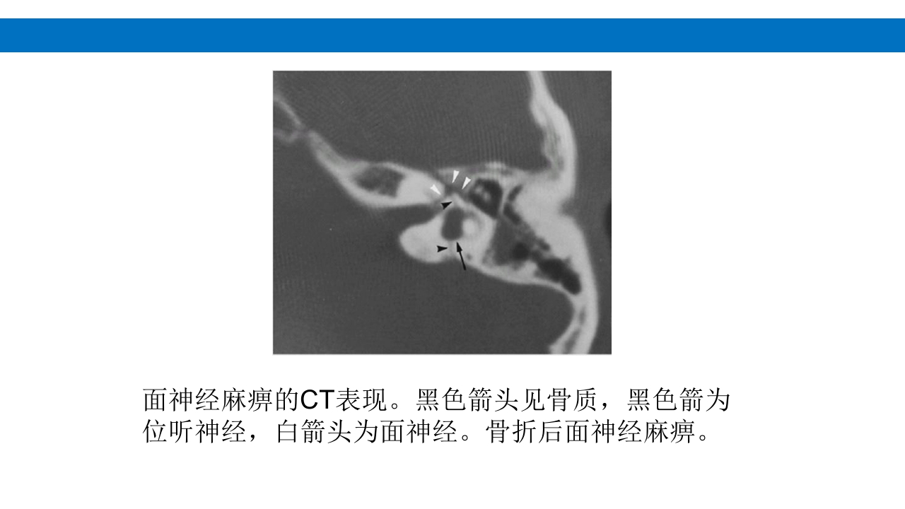 颅脑损伤的并发症及后遗症PPT课件54