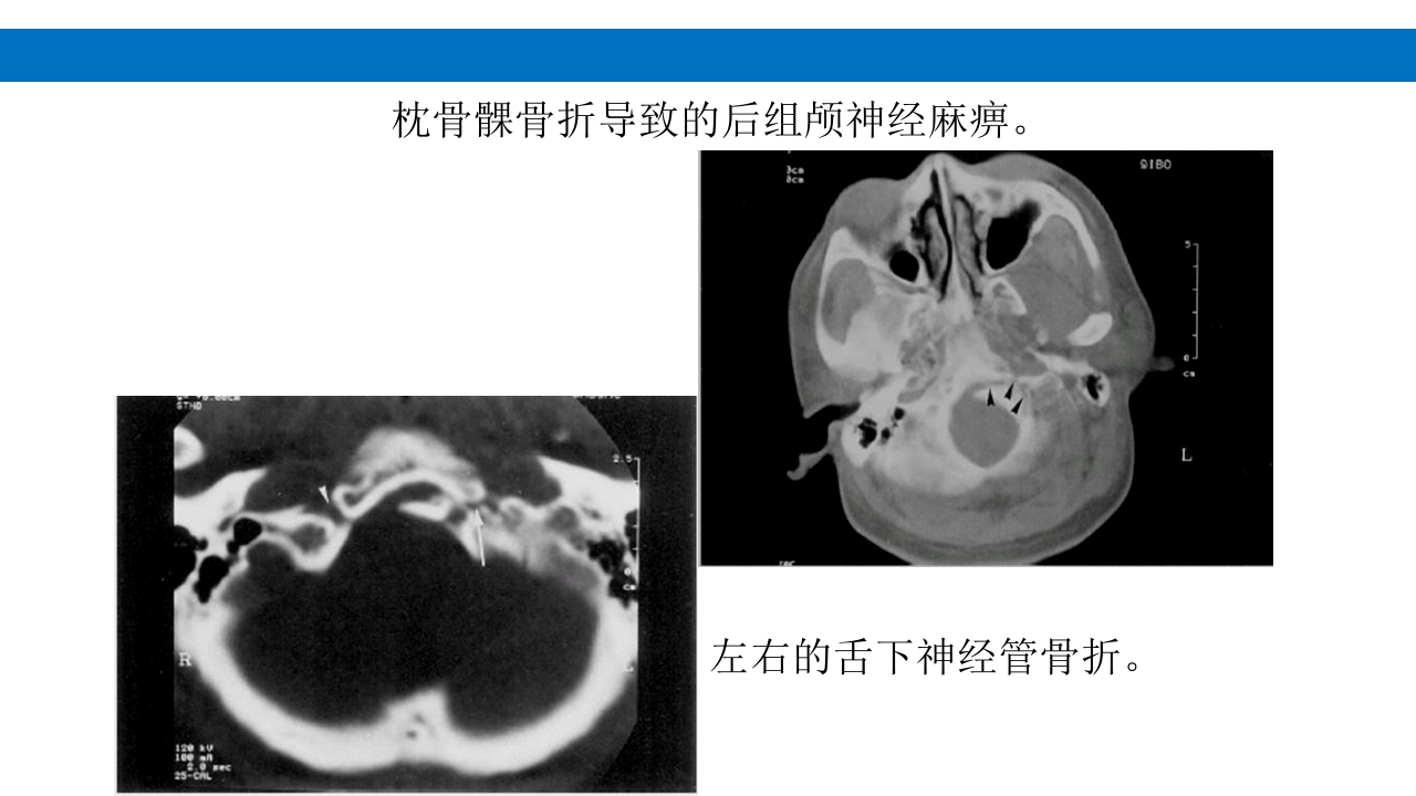 颅脑损伤的并发症及后遗症PPT课件56