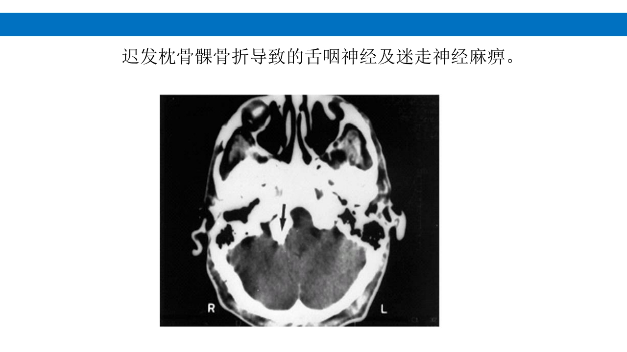 颅脑损伤的并发症及后遗症PPT课件57