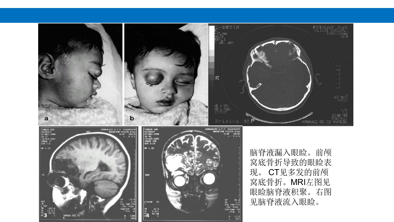 颅脑损伤的并发症及后遗症PPT课件59