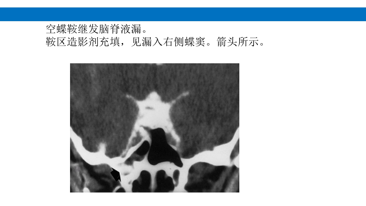 颅脑损伤的并发症及后遗症PPT课件60