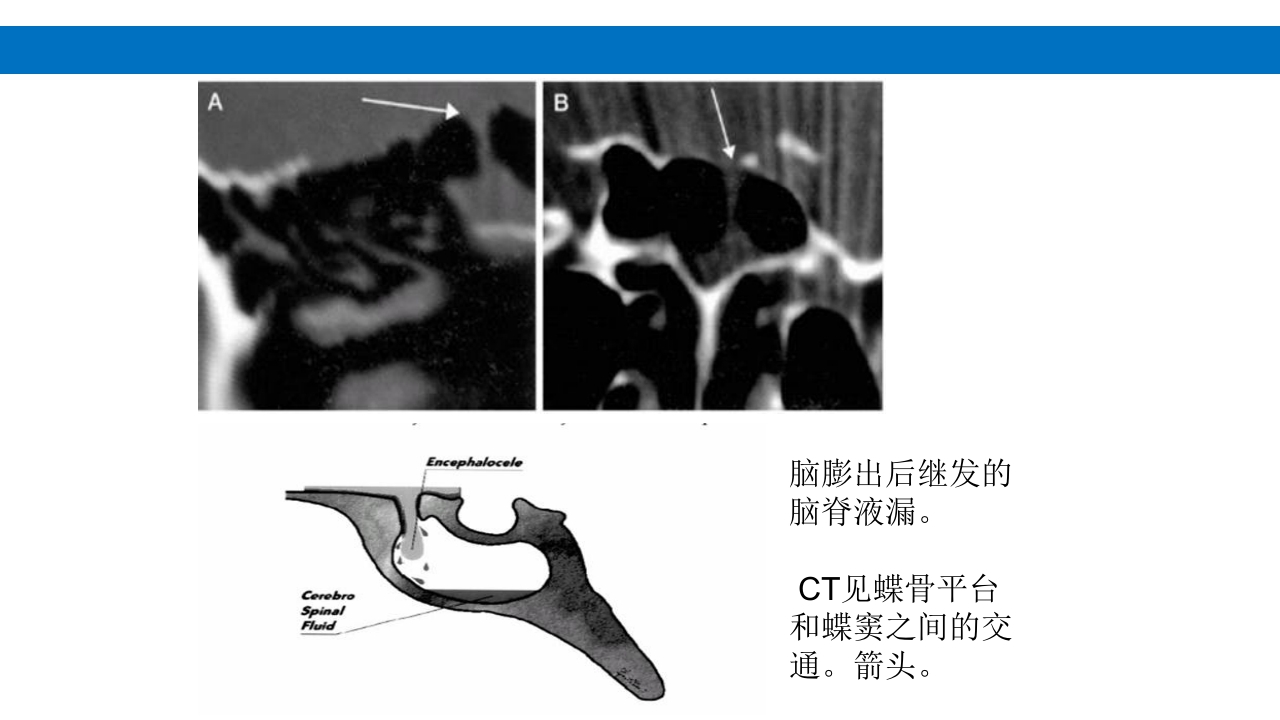 颅脑损伤的并发症及后遗症PPT课件61