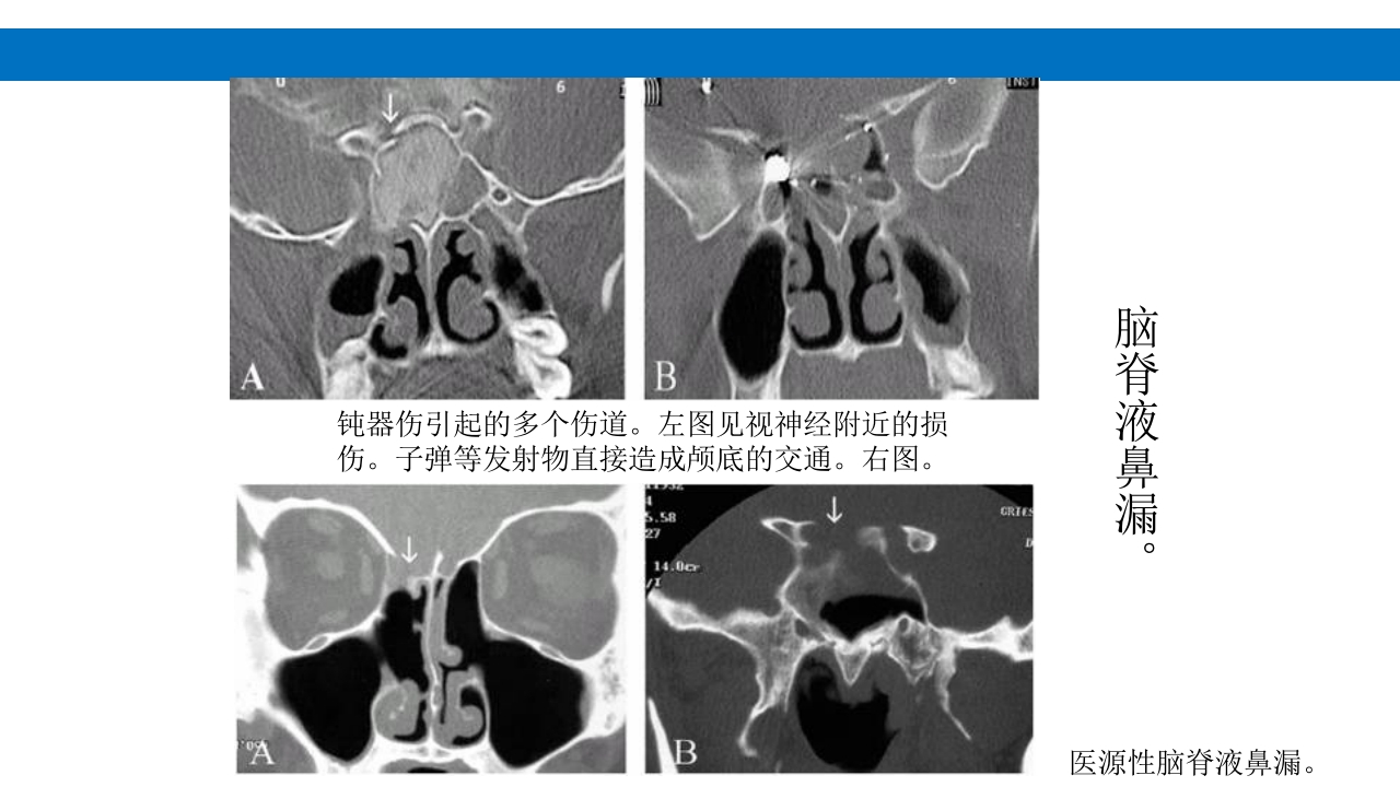 颅脑损伤的并发症及后遗症PPT课件62
