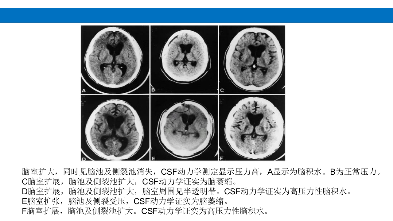 颅脑损伤的并发症及后遗症PPT课件65