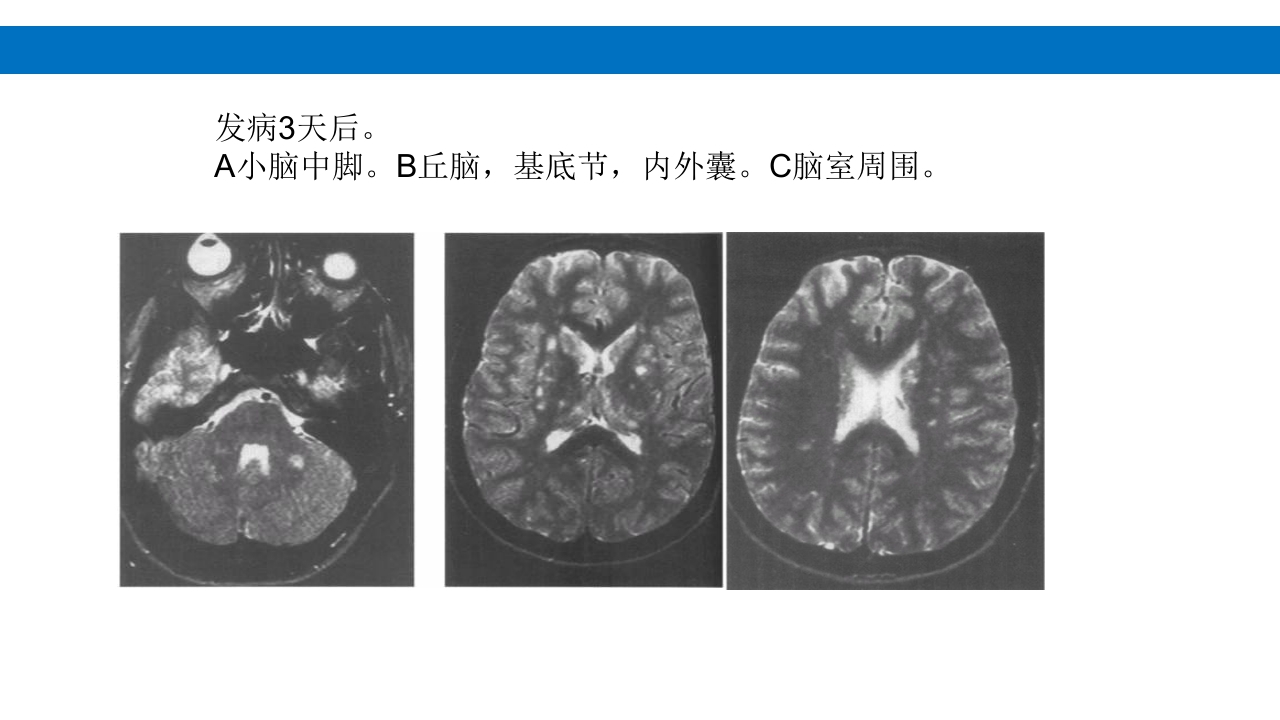 颅脑损伤的并发症及后遗症PPT课件67