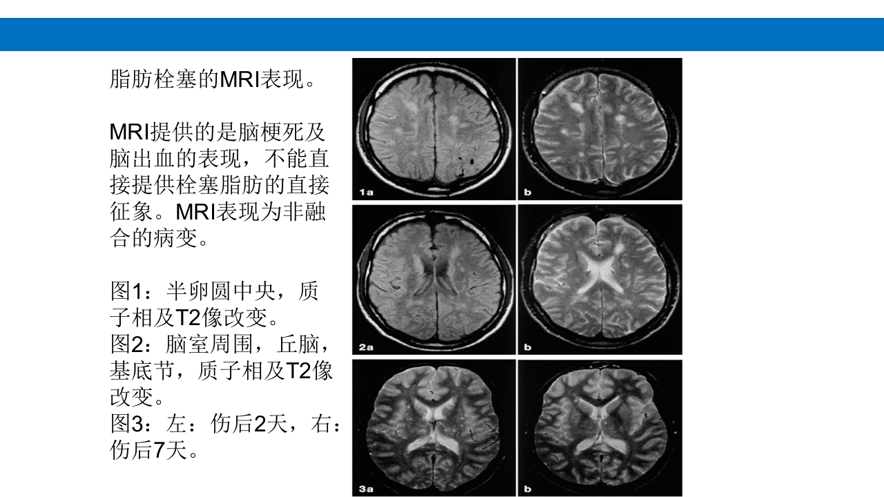 颅脑损伤的并发症及后遗症PPT课件68