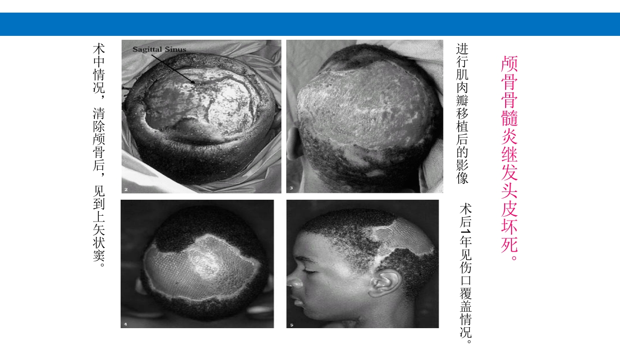 颅脑损伤的并发症及后遗症PPT课件6