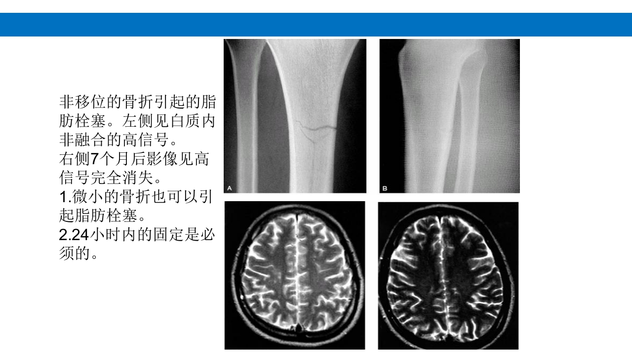 颅脑损伤的并发症及后遗症PPT课件70