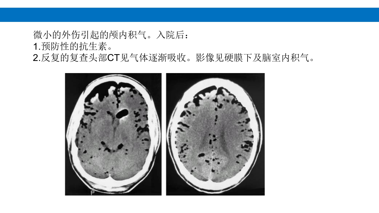 颅脑损伤的并发症及后遗症PPT课件73