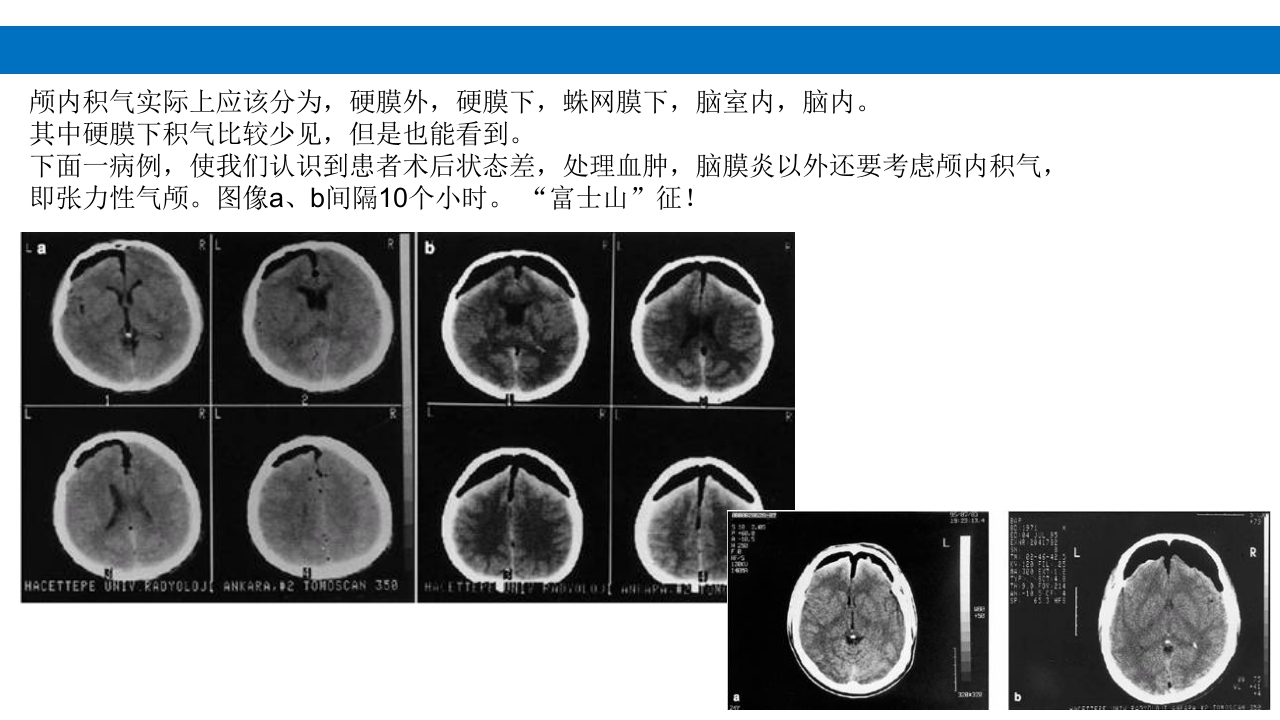 颅脑损伤的并发症及后遗症PPT课件74