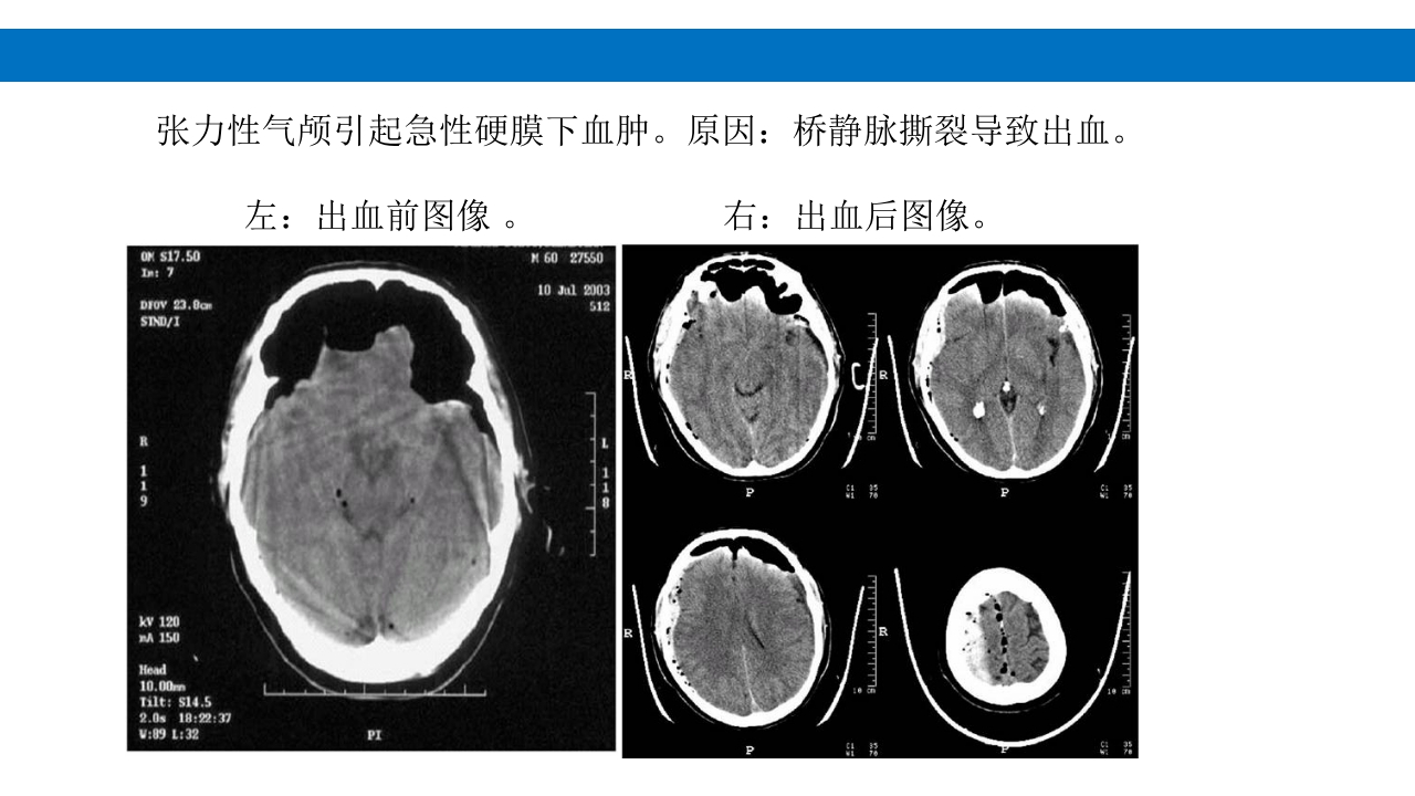 颅脑损伤的并发症及后遗症PPT课件75