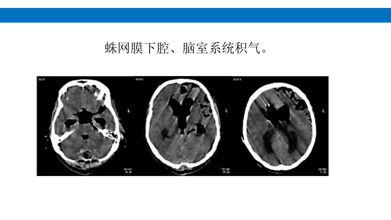 颅脑损伤的并发症及后遗症PPT课件76