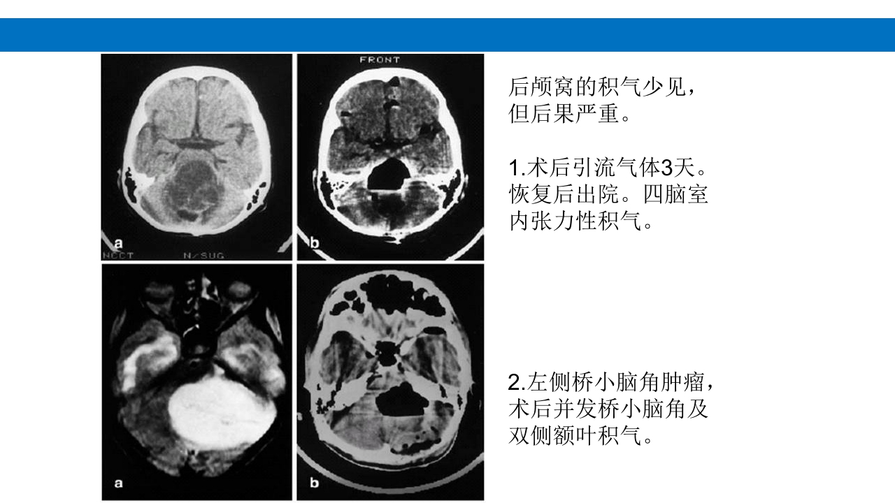 颅脑损伤的并发症及后遗症PPT课件77
