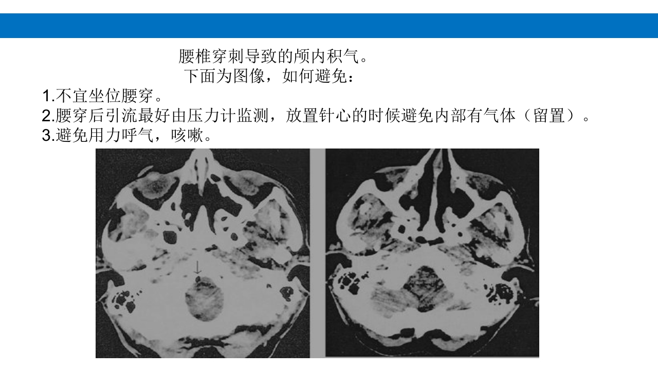 颅脑损伤的并发症及后遗症PPT课件78