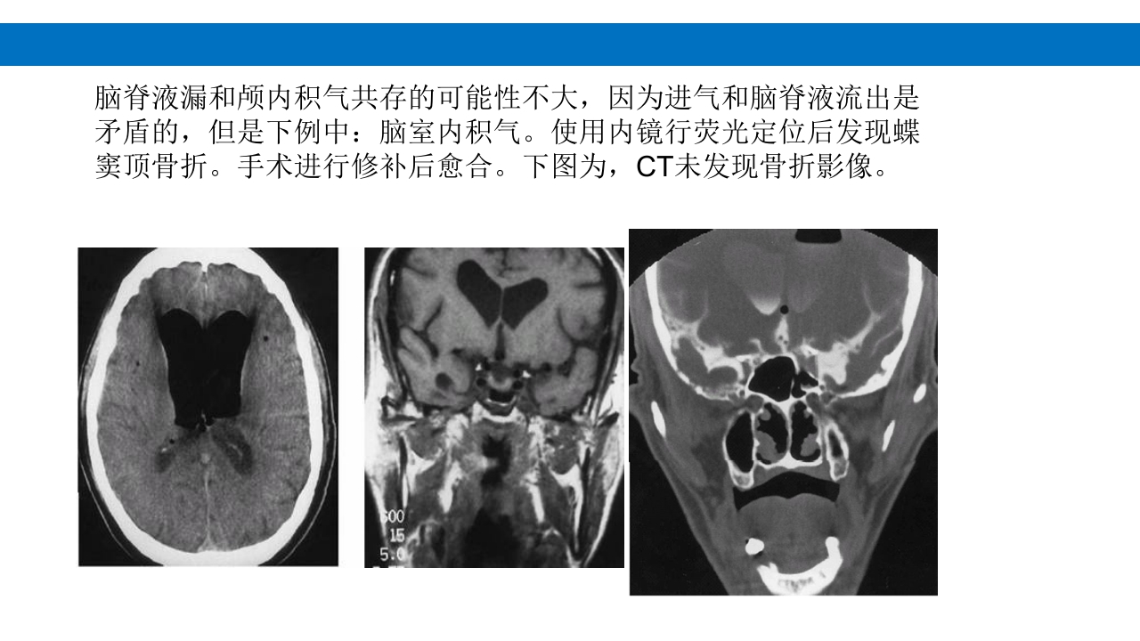颅脑损伤的并发症及后遗症PPT课件79