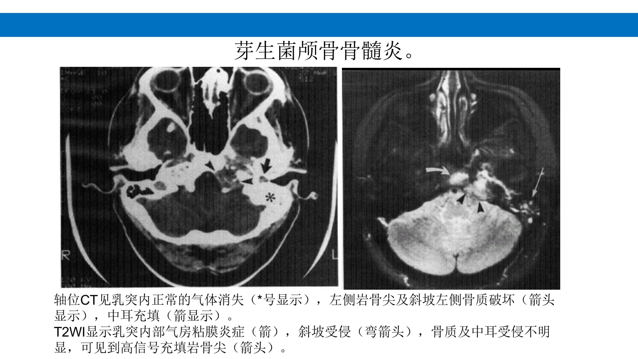 颅脑损伤的并发症及后遗症PPT课件7