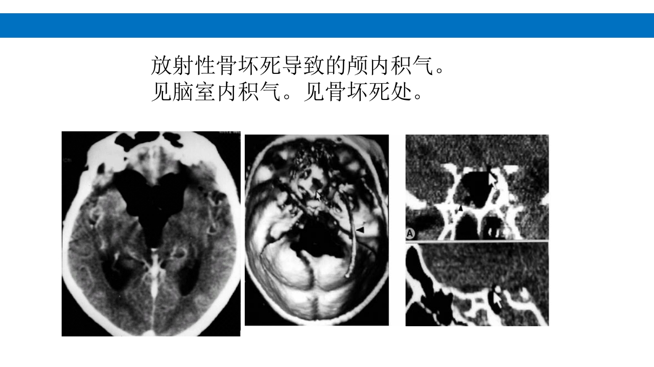 颅脑损伤的并发症及后遗症PPT课件80