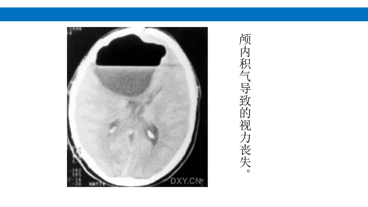 颅脑损伤的并发症及后遗症PPT课件81