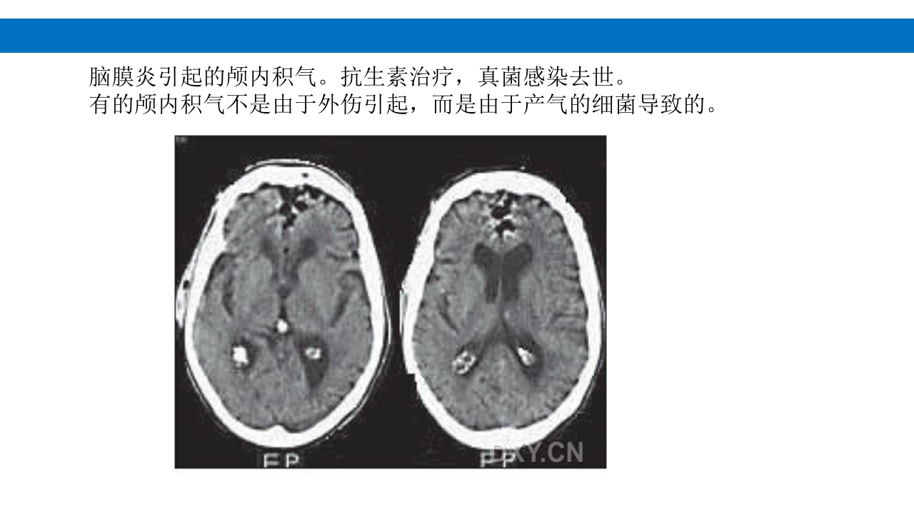 颅脑损伤的并发症及后遗症PPT课件82