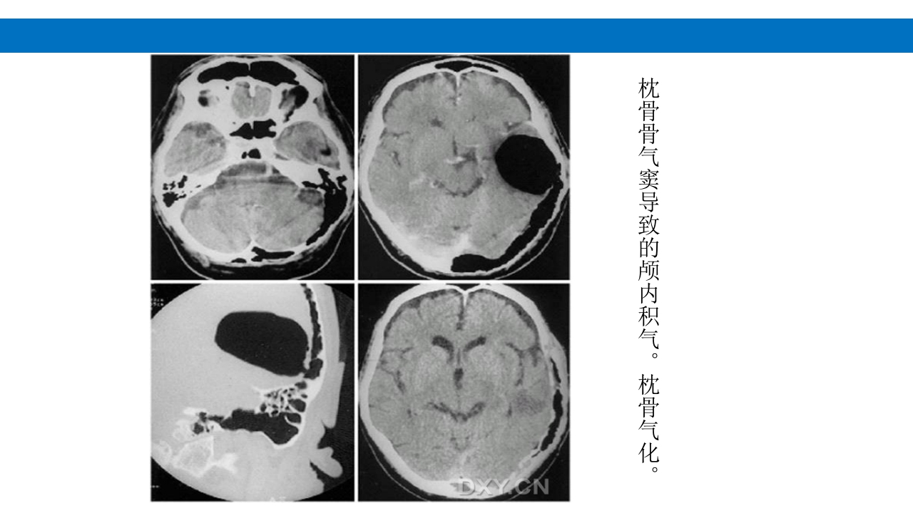 颅脑损伤的并发症及后遗症PPT课件83