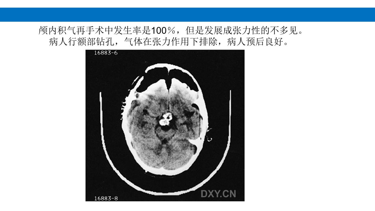 颅脑损伤的并发症及后遗症PPT课件84