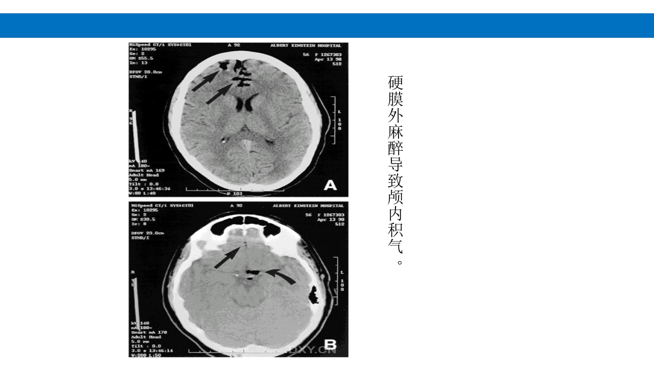 颅脑损伤的并发症及后遗症PPT课件85