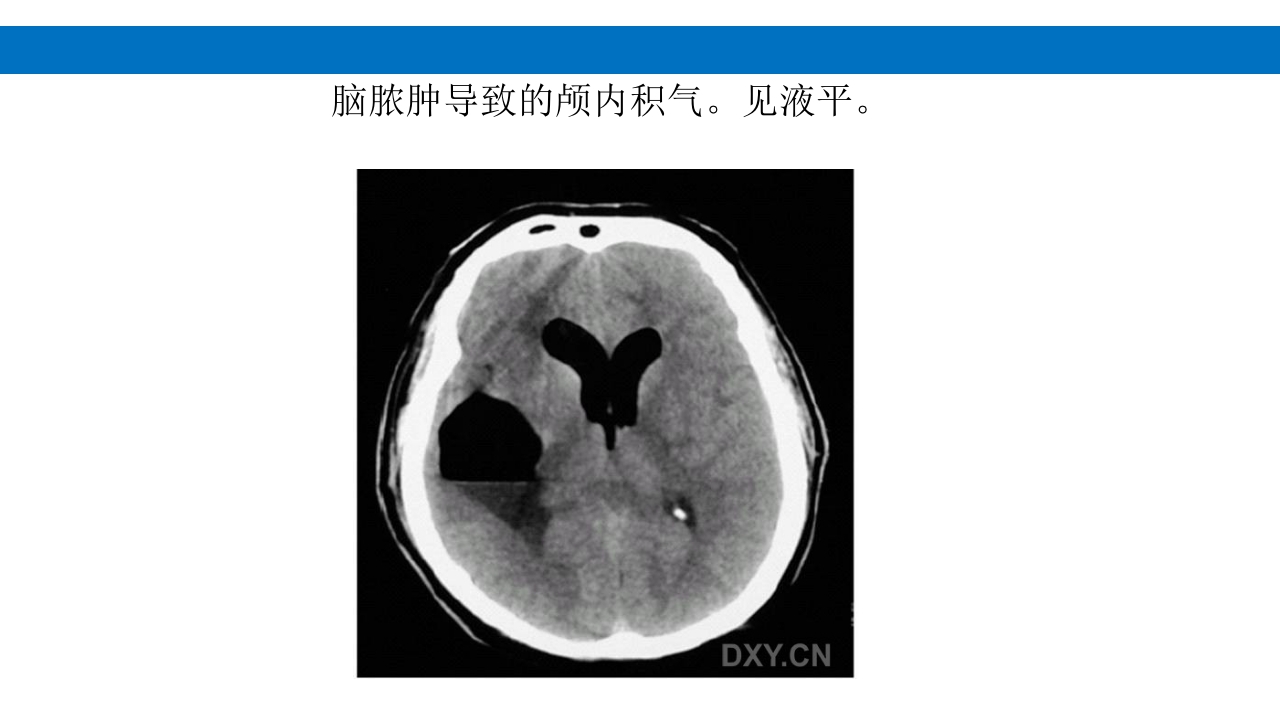 颅脑损伤的并发症及后遗症PPT课件86