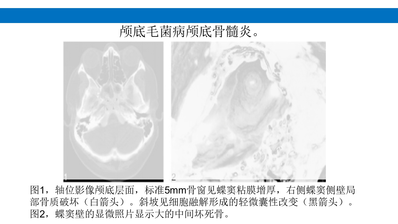 颅脑损伤的并发症及后遗症PPT课件8