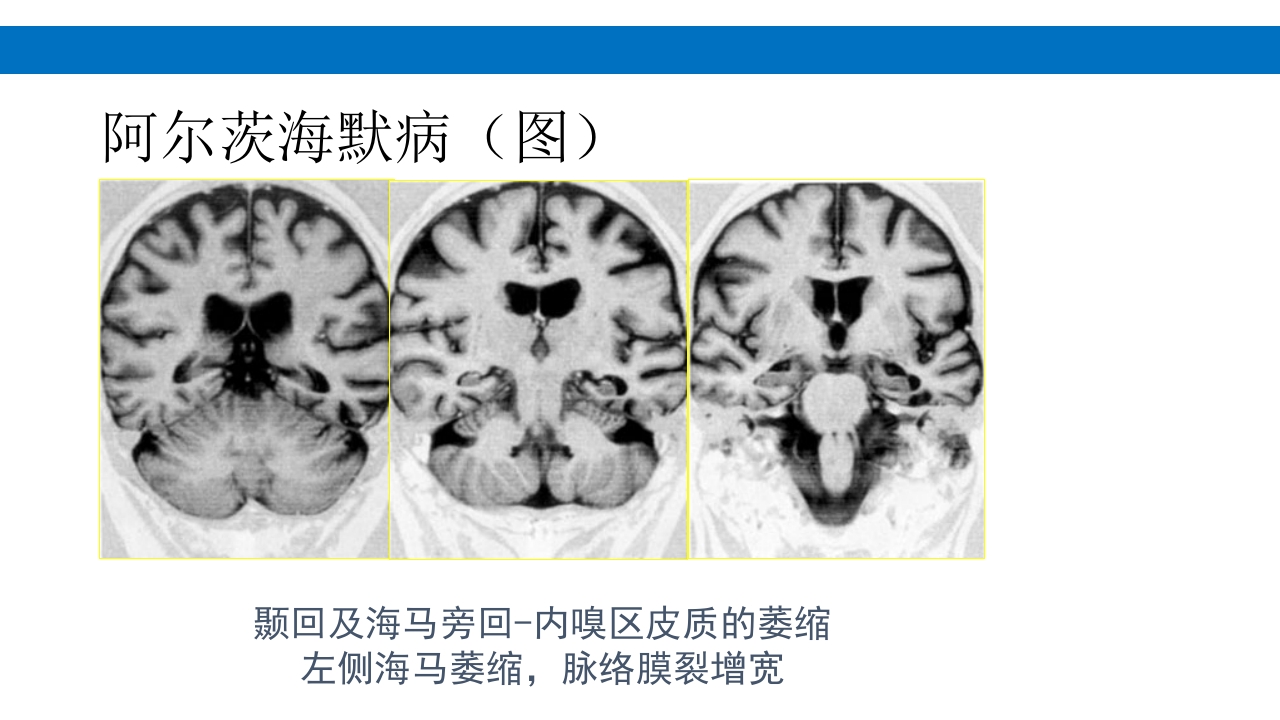 颅脑损伤的并发症及后遗症PPT课件93