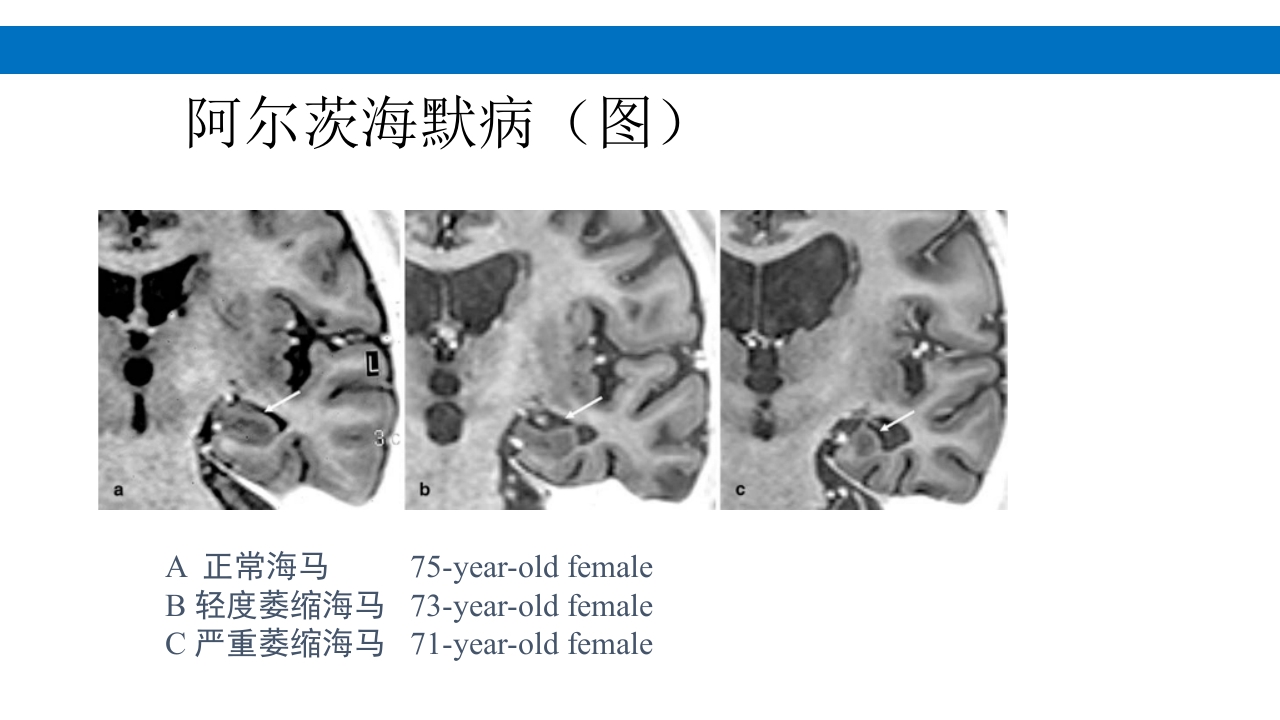 颅脑损伤的并发症及后遗症PPT课件94