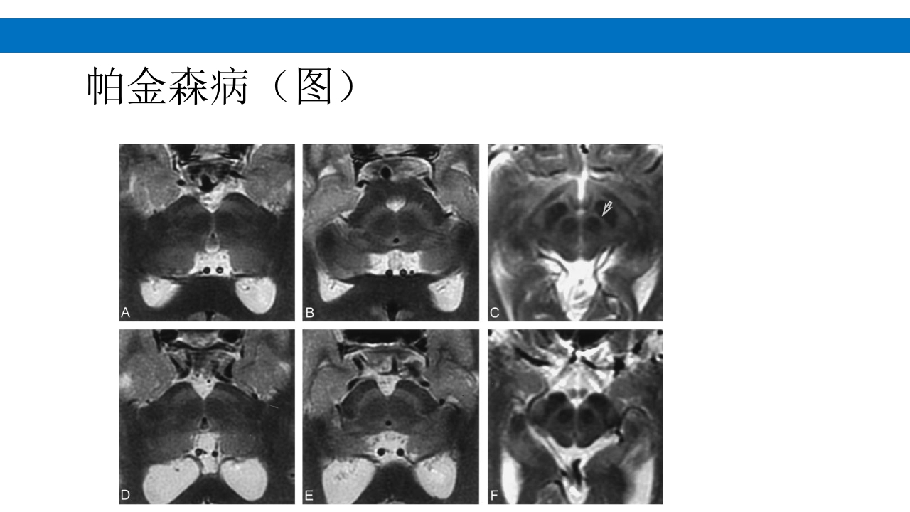 颅脑损伤的并发症及后遗症PPT课件98