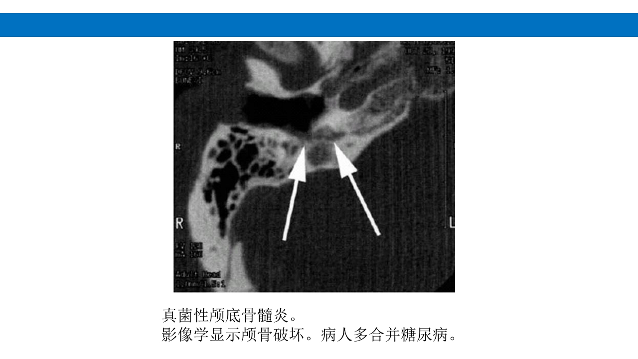 颅脑损伤的并发症及后遗症PPT课件9