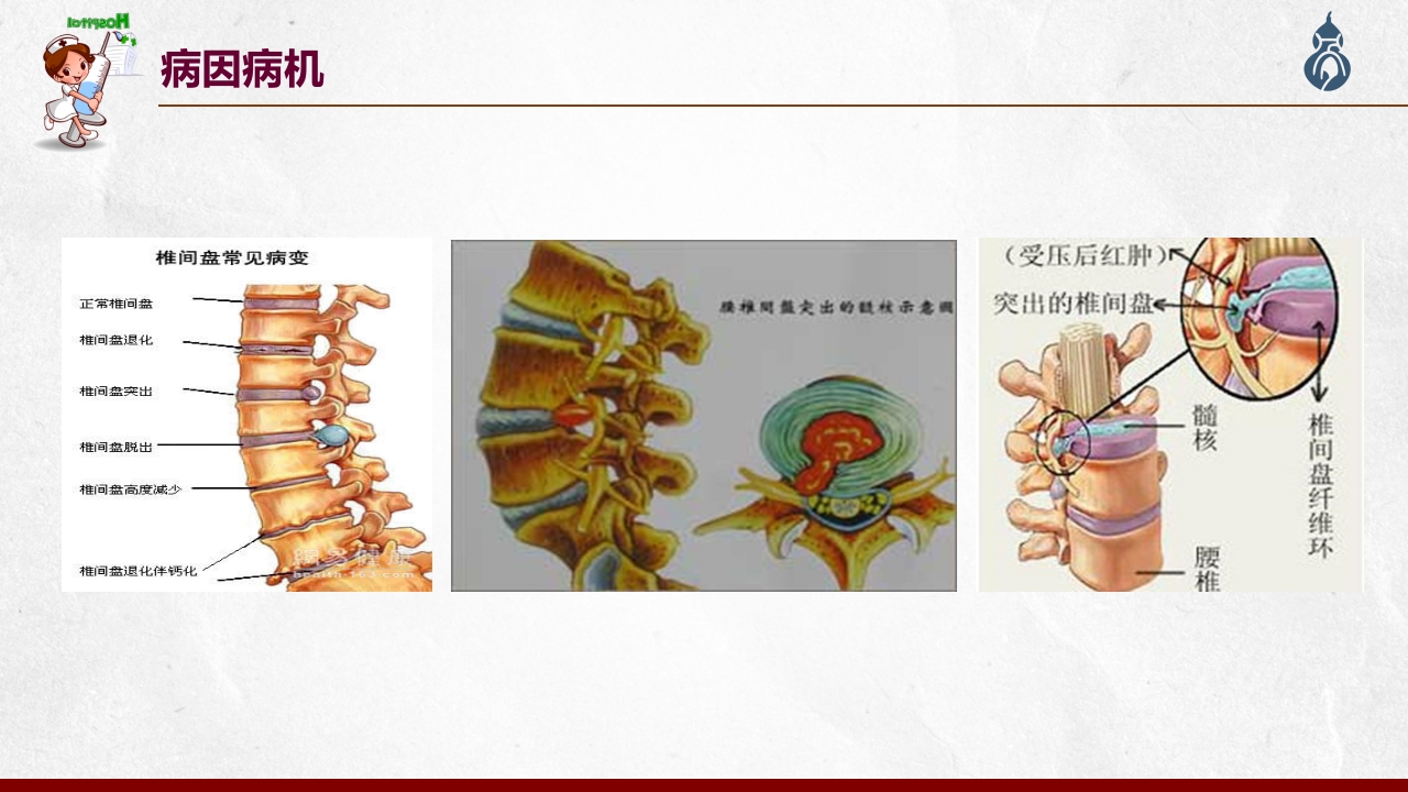 腰椎间盘突出患者护理查房PPT课件18
