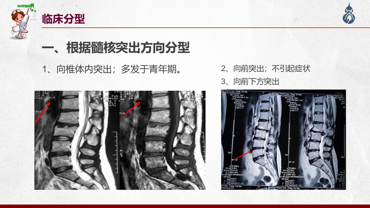 腰椎间盘突出患者护理查房PPT课件20