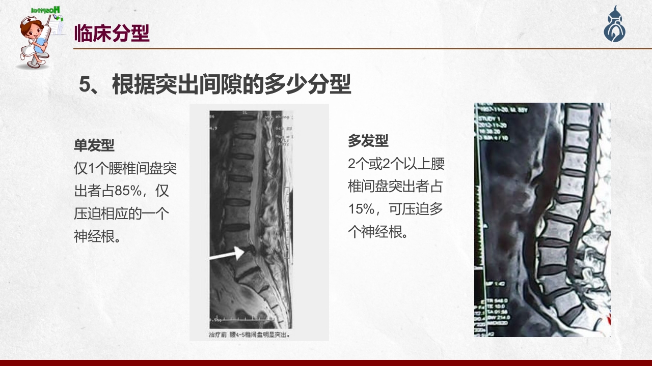 腰椎间盘突出患者护理查房PPT课件25