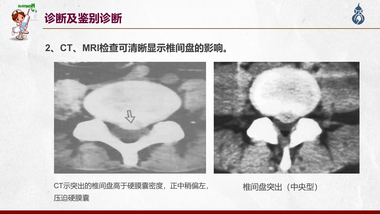 腰椎间盘突出患者护理查房PPT课件39