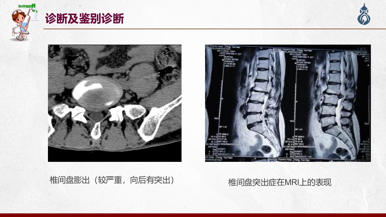 腰椎间盘突出患者护理查房PPT课件40