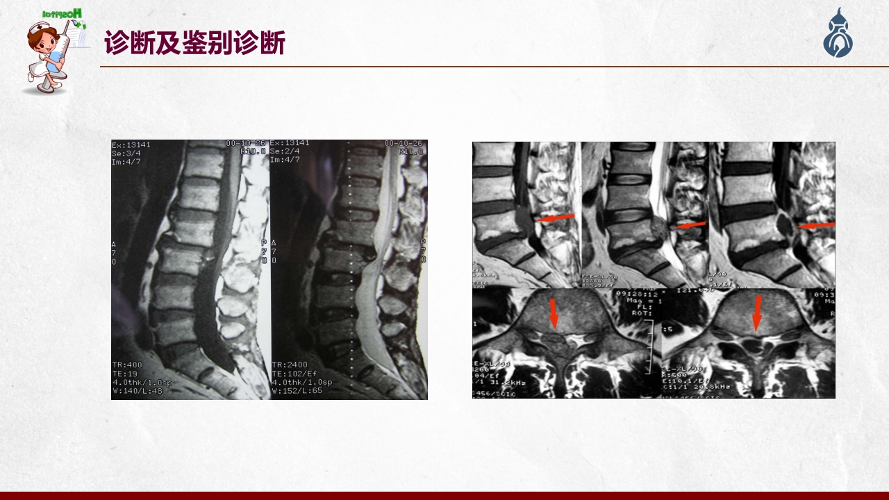 腰椎间盘突出患者护理查房PPT课件41