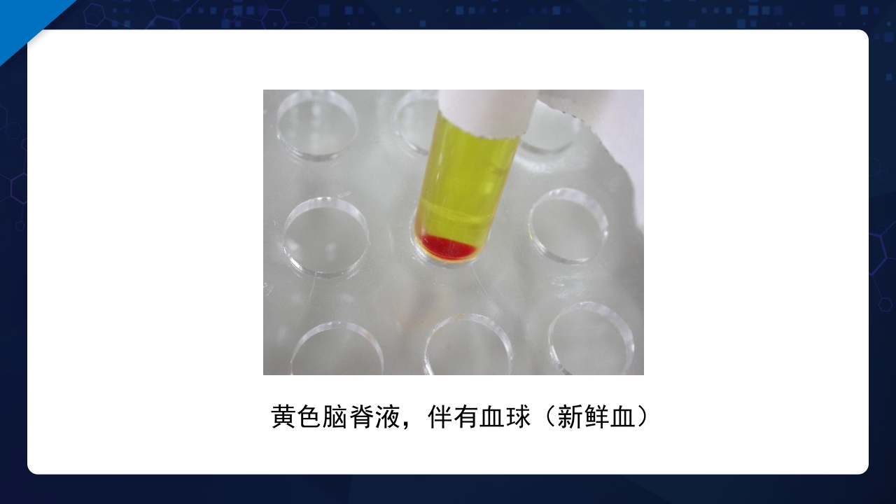 脑脊液检验PPT课件14