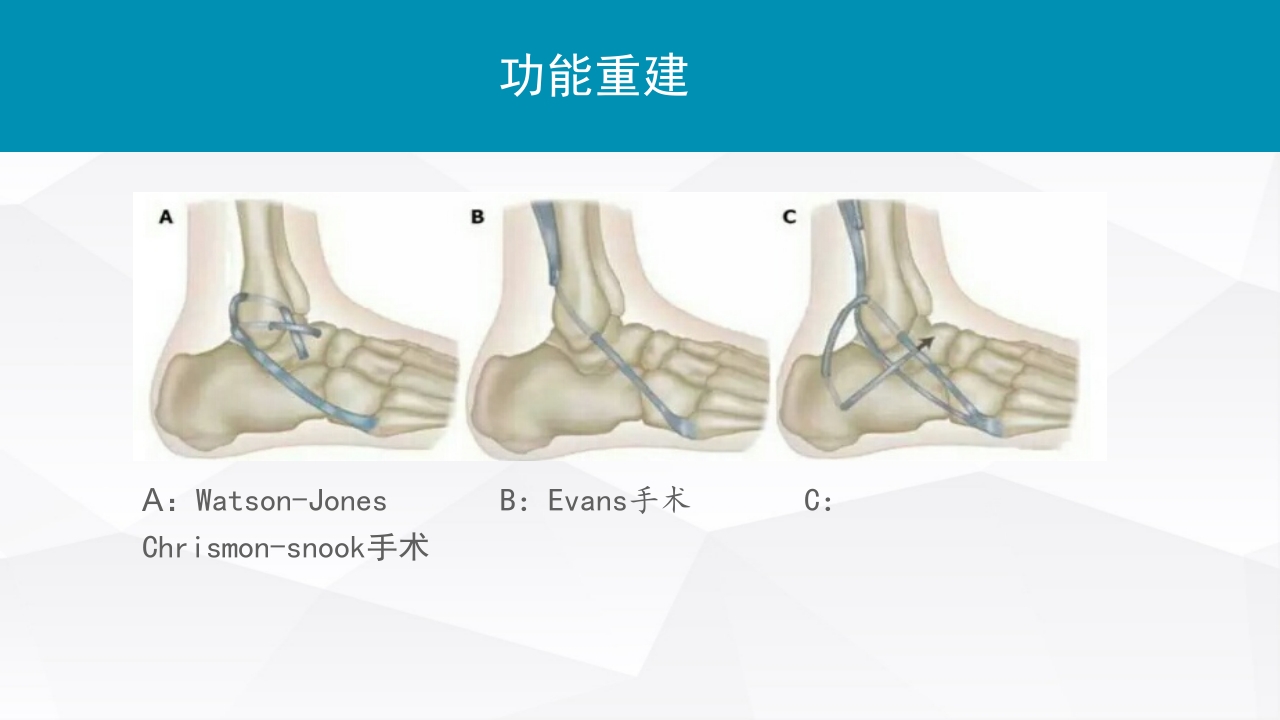 踝关节扭伤的评估和治疗PPT课件17