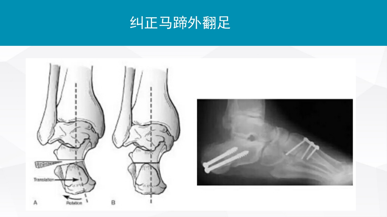 踝关节扭伤的评估和治疗PPT课件21