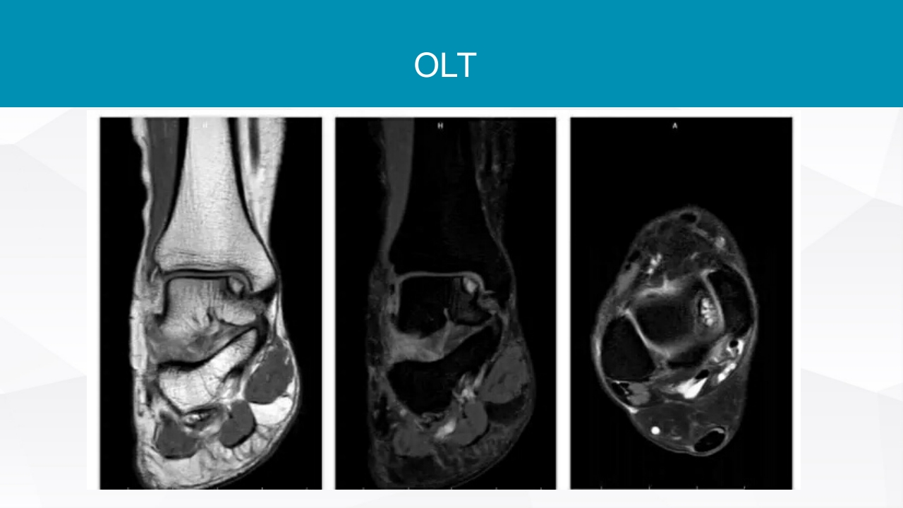 踝关节扭伤的评估和治疗PPT课件23